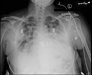 Acute Respiratory Distress Syndrome due to Influenza A Treated