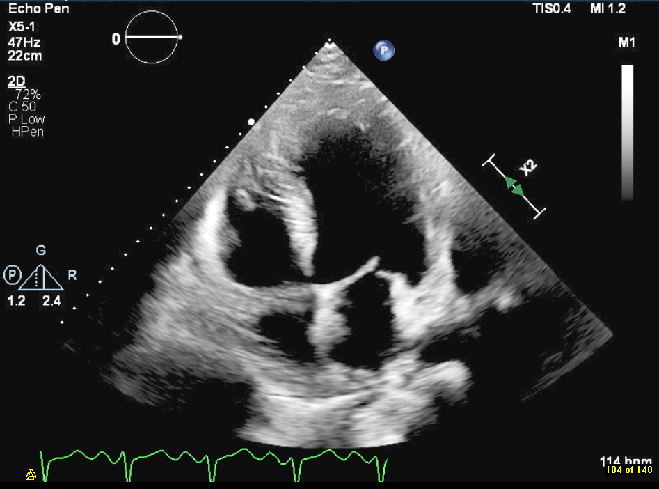 Echocardiographic features of left ventricular dysfunction and outcomes in  chronic kidney disease